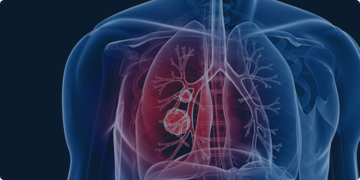 Методы лечения рака лёгкого